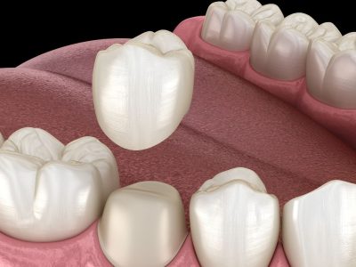 Dental Crown Solusi Gigi Rusak Agar Lebih Kuat
