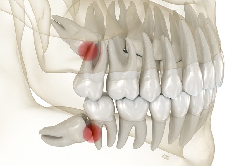 Gigi Bungsu Tumbuh Miring Bisa Sebabkan Masalah Serius