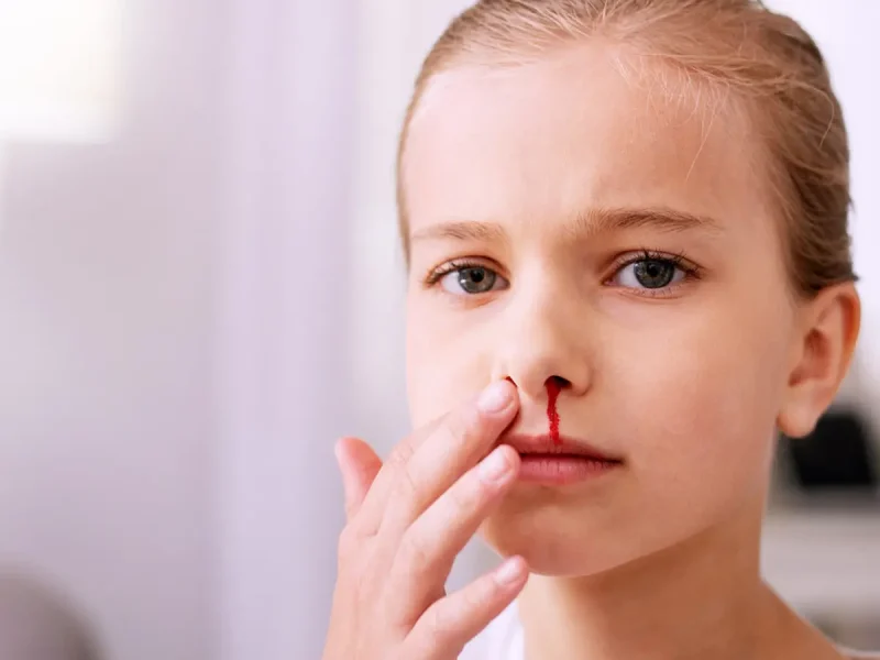 Mimisan Sering Terjadi Tanpa Gejala Lain Terlebih Dahulu