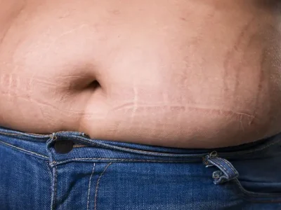 Cushing Syndrome Dapat Timbulkan Beragam Gejala Serius