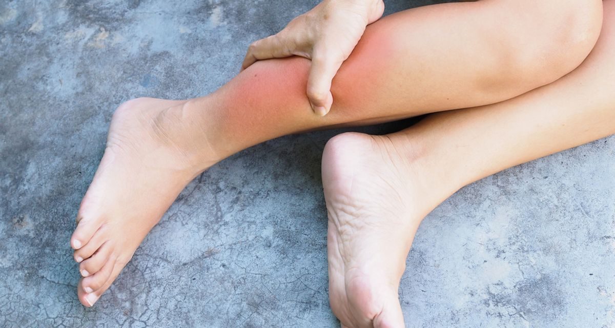 Betis Bengkak, Penyebab, Gejala, dan Cara Mengatasinya